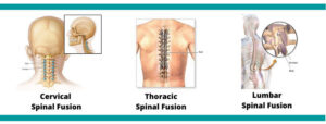 Medical illustration showing different types of thoracic spine surgery, including discectomy, fusion, and laminectomy procedures.