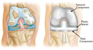 Medical illustration comparing a damaged arthritic knee joint with a modern knee replacement implant, highlighting the femoral component, tibial component, and plastic spacer used in knee arthroplasty surgery.