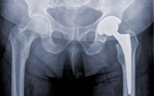 Pelvic X-ray showing a total hip replacement implant in the left hip joint following hip arthroplasty surgery.