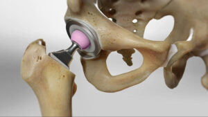 Close-up medical model of a hip replacement implant demonstrating artificial joint components used during hip arthroplasty surgery and recovery planning.