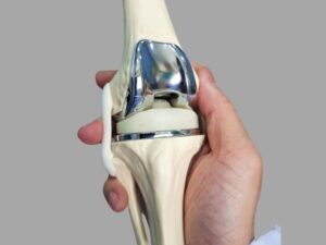 Close-up of a knee replacement implant model held by a medical professional, demonstrating components used in knee arthroplasty surgery.