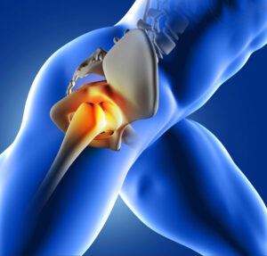 Medical illustration of an inflamed hip joint highlighting pain and degeneration in the hip socket and femur associated with hip arthroplasty conditions.