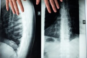 Doctor reviewing chest and spine X-ray images during post-operative recovery monitoring after minimally invasive spine surgery.