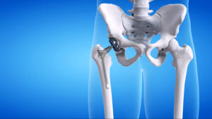 Medical illustration showing a hip replacement implant positioned within the pelvis and femur during post-operative recovery after hip arthroplasty surgery.