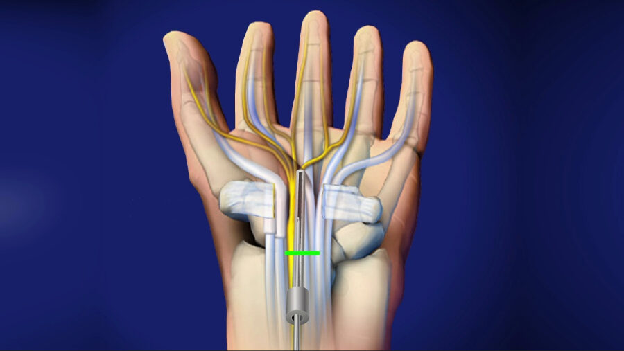 Medical illustration of carpal tunnel release surgery showing surgical instruments relieving pressure on the median nerve within the wrist and hand.