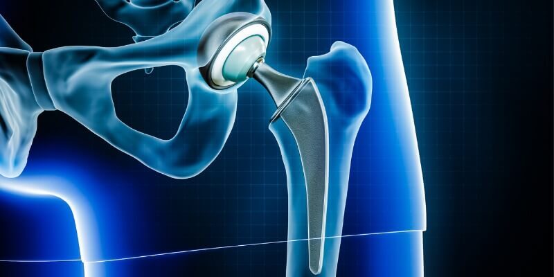 Medical illustration of a hip replacement implant used in hip arthroplasty surgery, showing the artificial joint positioned within the pelvis and femur.