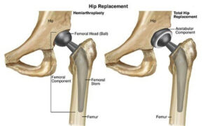 Educational diagram comparing hemiarthroplasty and total hip replacement procedures, showing the implanted femoral and acetabular components used in hip arthroplasty surgery.