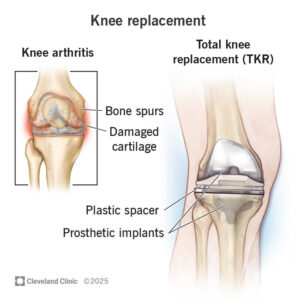 Educational illustration comparing an arthritic knee joint with a total knee replacement implant, highlighting damaged cartilage, bone spurs, and prosthetic knee components used in knee arthroplasty surgery.