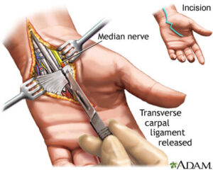 Medical illustration of open carpal tunnel release surgery showing the median nerve and transverse carpal ligament during a surgical decompression procedure.