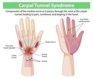 Educational infographic explaining carpal tunnel syndrome, showing compression of the median nerve in the wrist and areas of pain, numbness, and tingling in the hand and fingers.