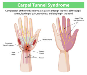 Educational infographic explaining carpal tunnel syndrome, showing compression of the median nerve in the wrist and areas of pain, numbness, and tingling in the hand and fingers.