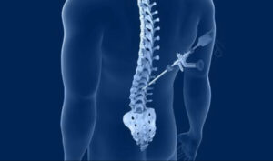 Medical illustration of minimally invasive spine surgery showing surgical instruments accessing the spine through a small incision in the lower back.