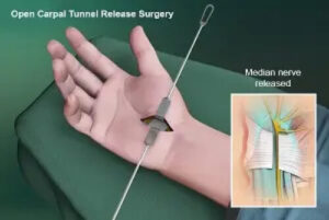 Medical illustration of open carpal tunnel release surgery showing a surgical incision in the wrist and decompression of the median nerve during the procedure.