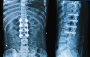 Spinal X-ray images showing metal rods and screws implanted during spinal fusion surgery for stabilization and spinal correction.