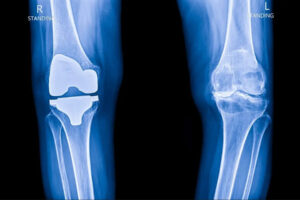 Standing knee X-ray comparison showing a total knee replacement implant in one knee and degenerative joint changes in the opposite knee before knee arthroplasty surgery.