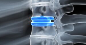 Medical illustration showing an artificial spinal disc implant and recovery progression after artificial disc replacement surgery