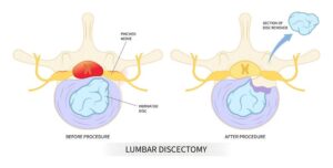 Medical illustration showing lumbar disc herniation and nerve compression causing symptoms before microdiscectomy surgery