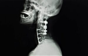Cervical spine X-ray showing spinal fusion hardware used to stabilize the neck after cervical fusion surgery