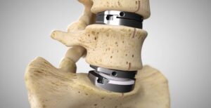 Medical illustration of an artificial spinal disc implant used to answer common questions about artificial disc replacement surgery