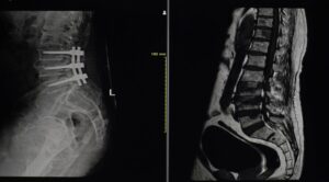 Lumbar spine X-ray and MRI images used to evaluate spinal conditions and answer common questions about lumbar fusion surgery