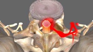 Medical illustration of a herniated spinal disc and compressed nerve used to explain common microdiscectomy questions