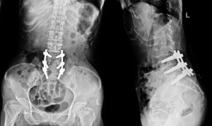 Post-operative lumbar spine X-ray showing spinal fusion hardware, including rods and screws stabilizing the lower back