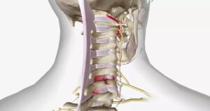 Medical illustration of the cervical spine showing vertebrae, discs, and spinal structures involved in cervical fusion surgery