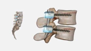 Medical illustration showing lumbar fusion surgery with spinal implants, screws, rods, and bone graft used to stabilize the lower spine
