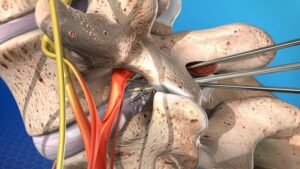 Medical illustration showing a microdiscectomy procedure relieving nerve compression caused by a herniated disc