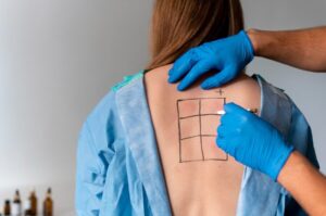 Healthcare professional marking the surgical site before microdiscectomy surgery preparation